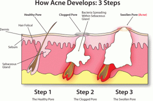 Acne scarring treatment - Alvinology