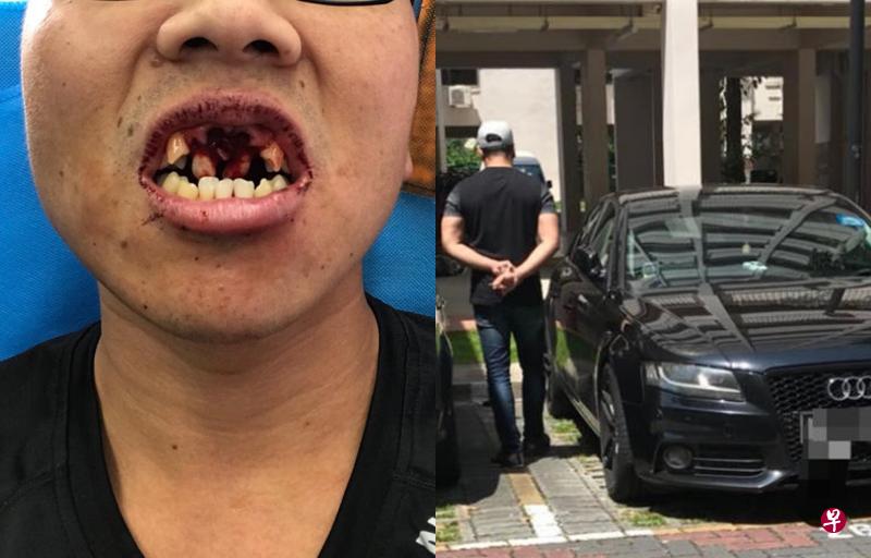 Man was punched by Grab driver and had his teeth knocked out! Man was punched by Grab driver and had his teeth knocked out! - Alvinology