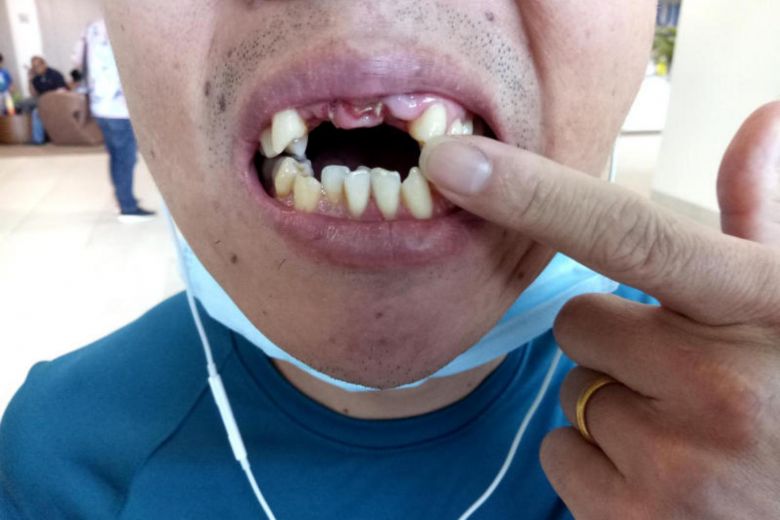 Man was punched by Grab driver and had his teeth knocked out! - Alvinology