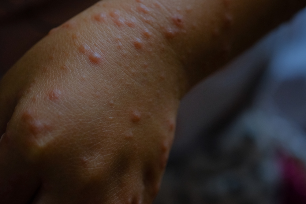 Mother brings children with Hand, Foot, and Mouth Disease to playground, netizens react - Alvinology