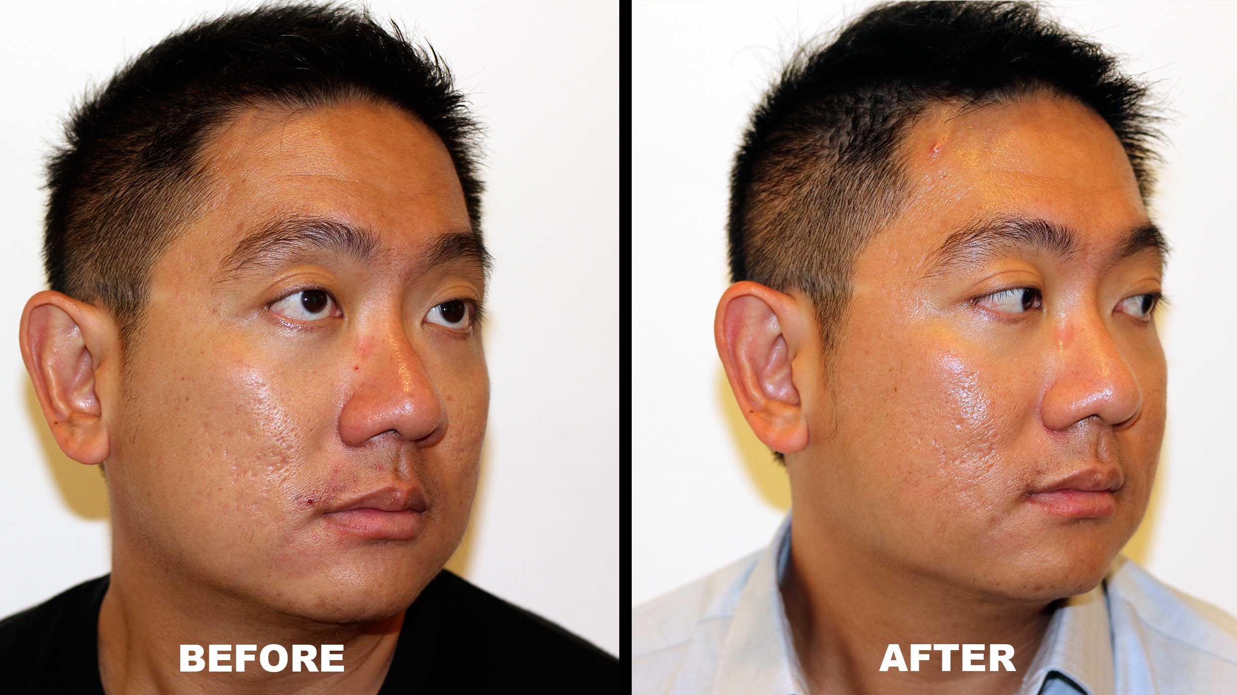 The Secret to Mark Lee's Acne Scar Treatment is Not That Secret - Alvinology