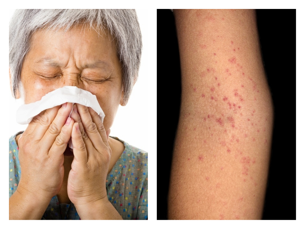 57-year-old woman with Covid-19 and dengue confirmed in Singapore - Alvinology
