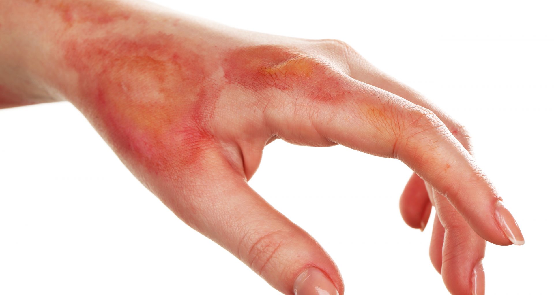 When to Seek Medical Attention for Burn Injuries - Alvinology