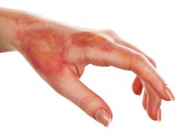 When to Seek Medical Attention for Burn Injuries - Alvinology