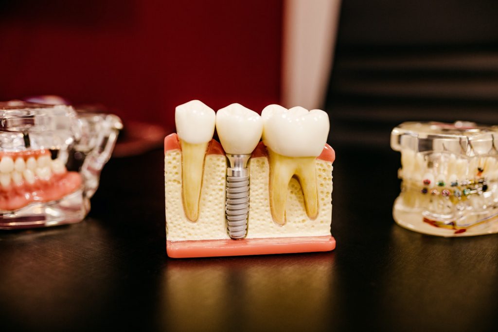 Veneers vs Lumineers: Which is Right for You?  - Alvinology