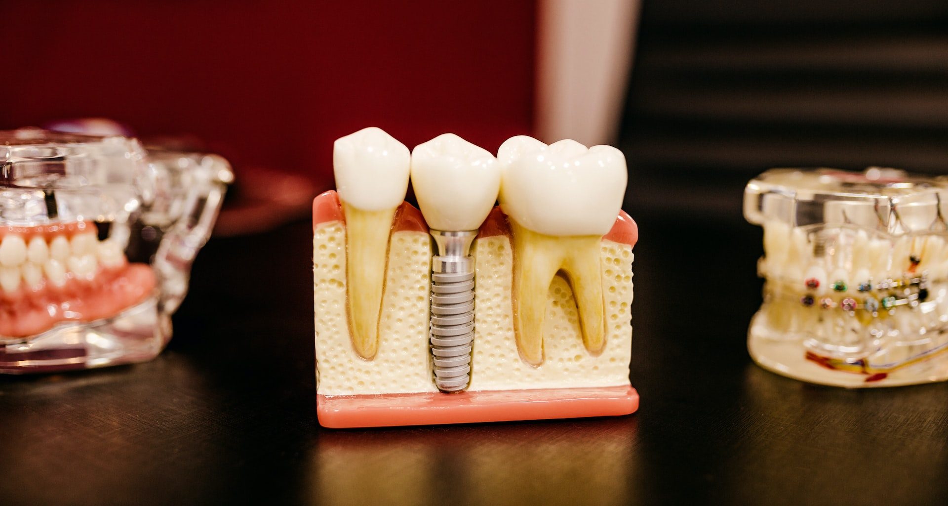 Veneers vs Lumineers: Which is Right for You?  - Alvinology