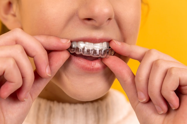 Top 4 Causes for Kids Getting Dental Veneers - Alvinology