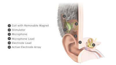 MED-EL Launches World’s First Commercially Available Totally Invisible Cochlear Implant - Alvinology