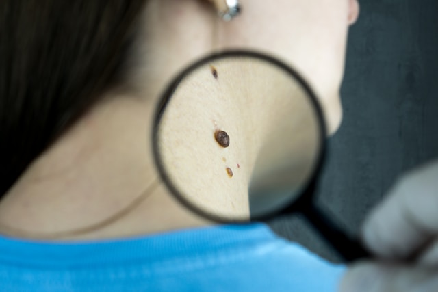 There Is No Best Treatment For Genital Warts - Alvinology
